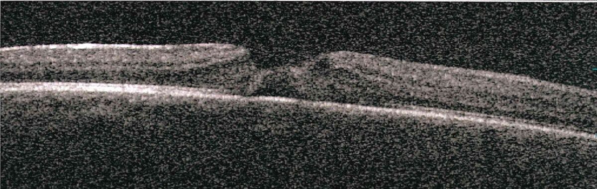 Optical coherence tomography (OCT) before treatment. (Image courtesy of Dr Roberto Pinelli)