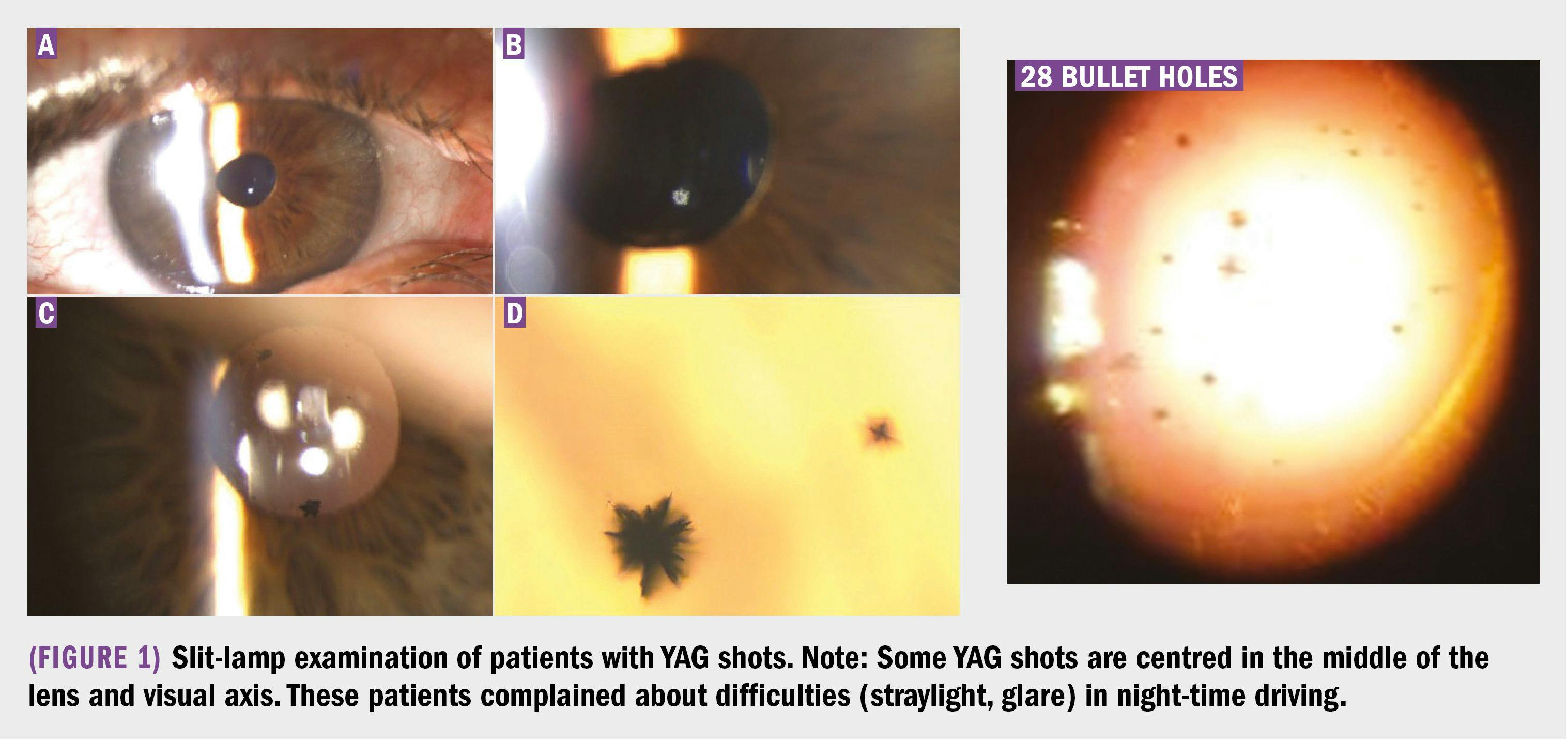 Slit-lamp examination of patients with YAG shots