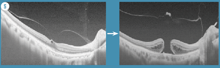 Figure 5. Mechanism of macular hole development. OCT findings clearly show that Shallow PVD, which leaves pinpoint adhesion in the fovea (left), is the cause of macular hole (right).