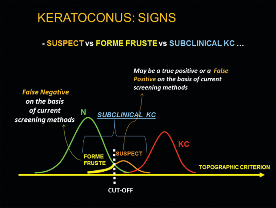 Figure 1. Topographic signs of keratoconus