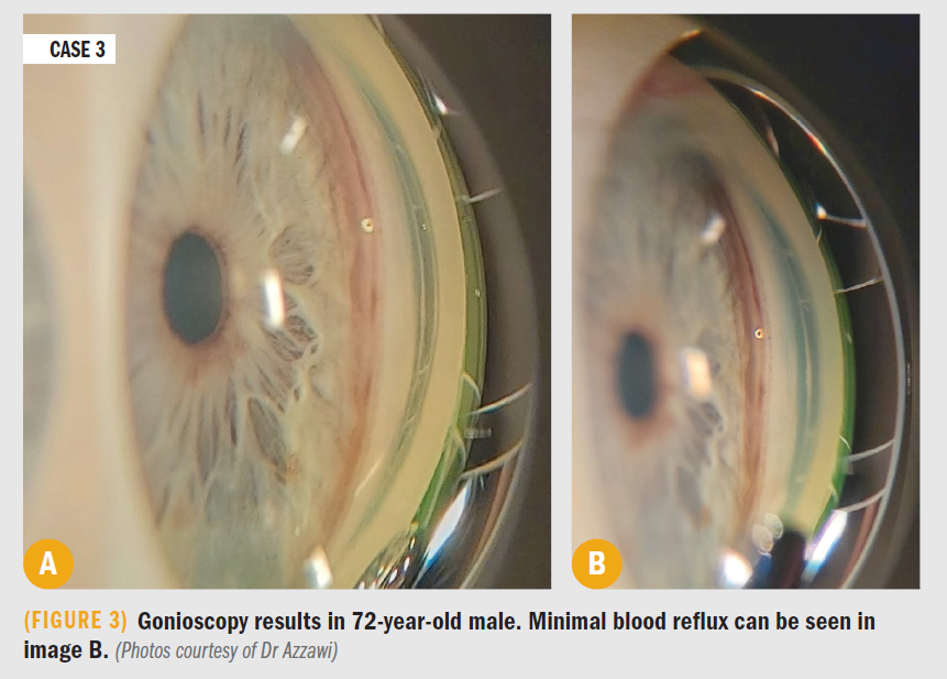 Gonioscopy results showing minimal blood flow