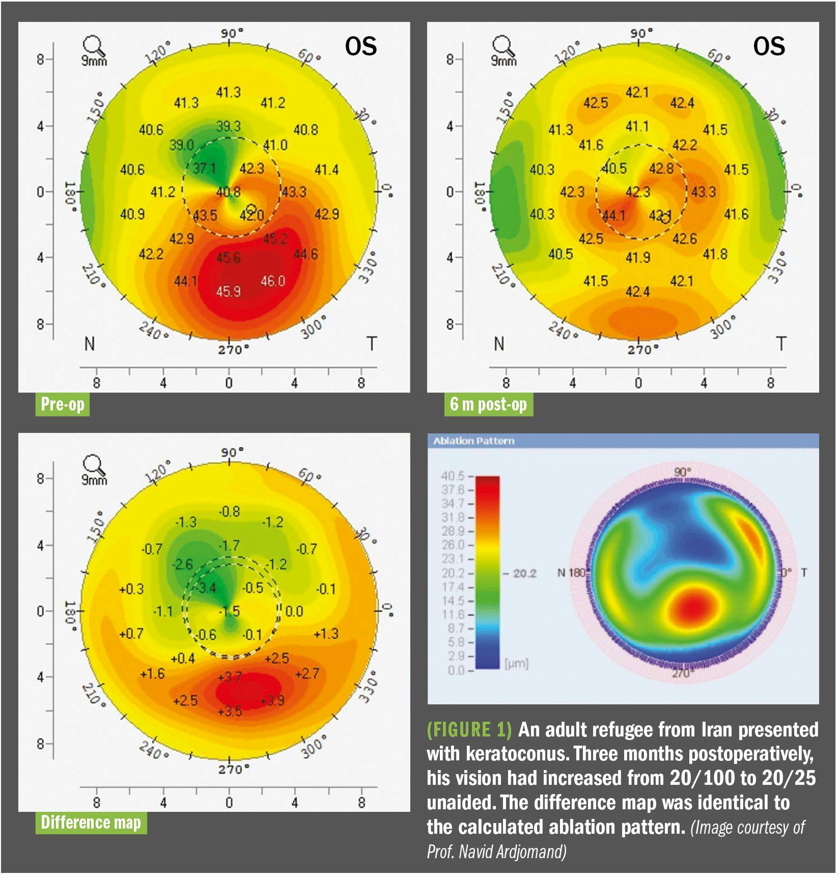 graphs showing visual difference in patient with keratoconus with treatment