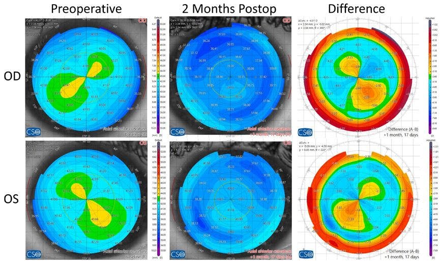 Figure 4. MS-39 (CSO, Florence, Italy) axial power maps before and at 2 months postop with difference maps demonstrating the perfect corneal vertex treatment centration and cyclotorsional control leading to mirror image cylindrical topography from preop to difference maps.