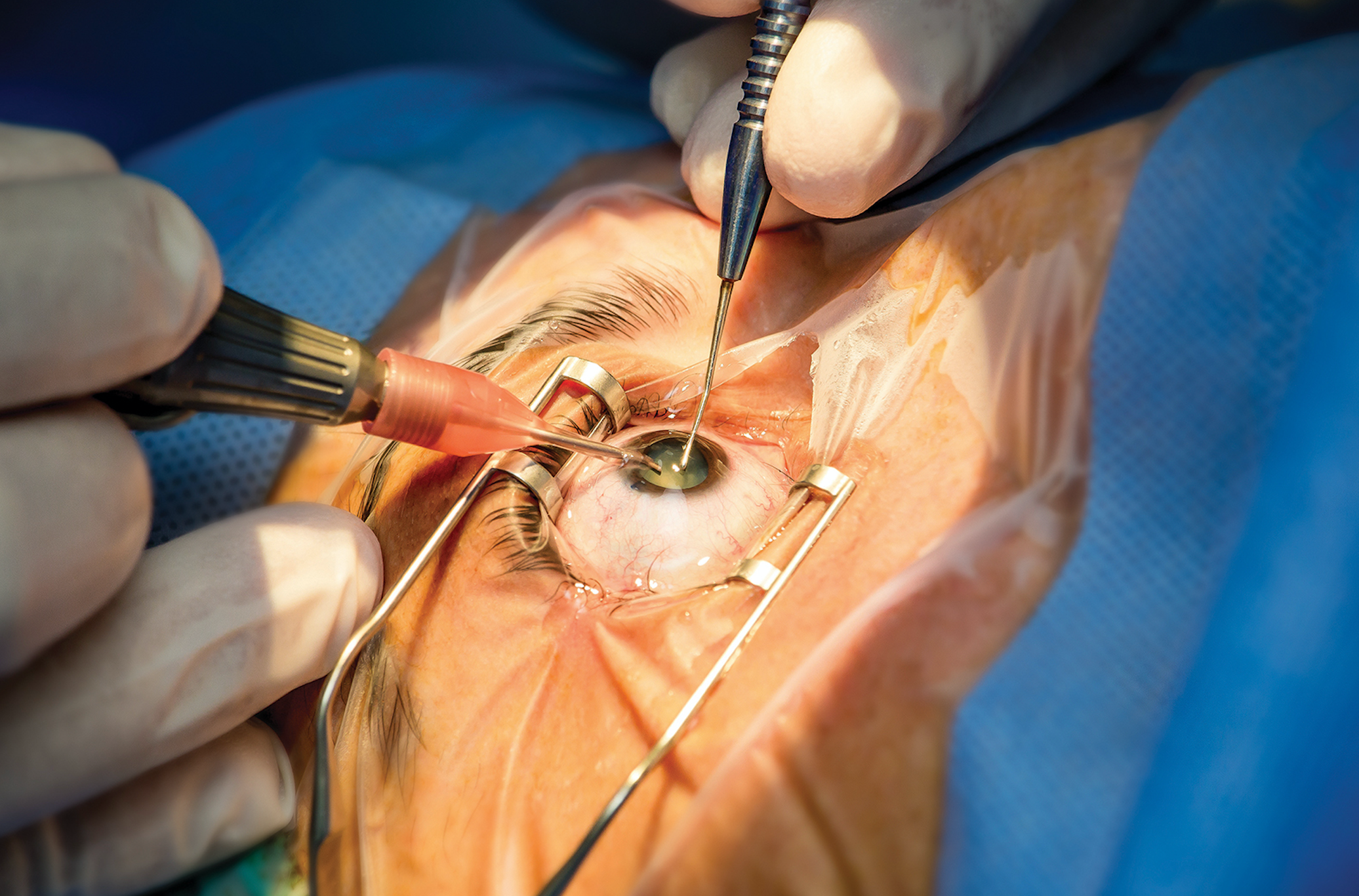 Vision implant surgery