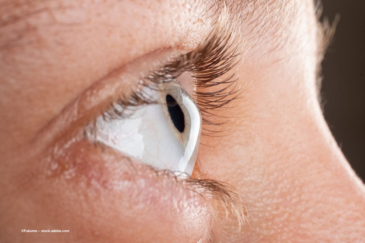 An eye shows signs of keratoconus, or corneal thinning. Image credit: ©Fukume – stock.adobe.com