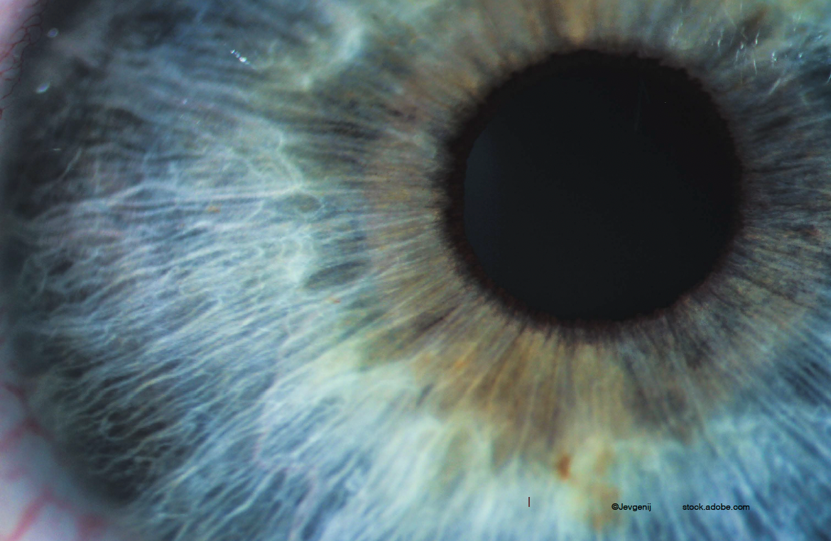 Imaging shows ocular changes in chronic thromboembolic pulmonary hypertension
