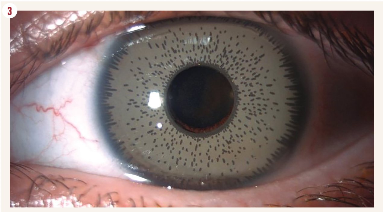 Figure 3. A NewColorIris implant causes severe edothelial cell loss and chronic uveitis.
