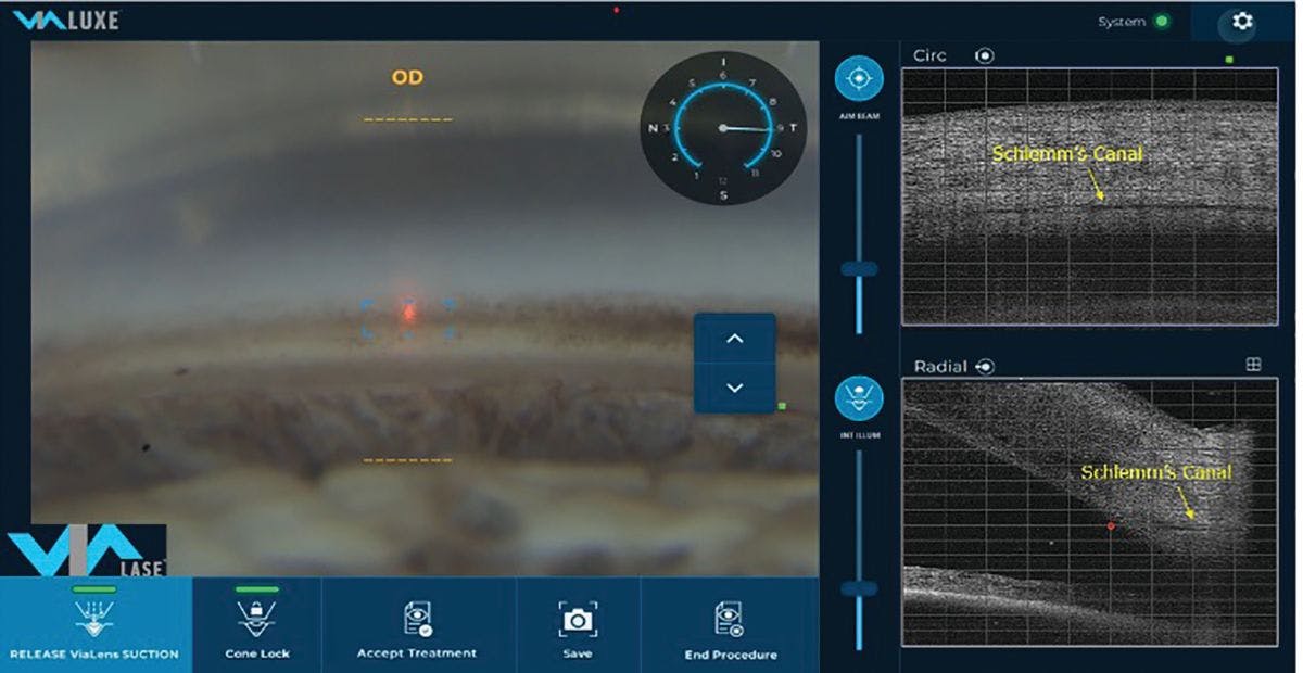 A screen capture shows data from the ViaLuxe Laser System, ViaLase. FLigHT procedure: a novel, image-guided femtosecond laser non-invasively creates precise trabeculotomy channels through the trabecular meshwork.