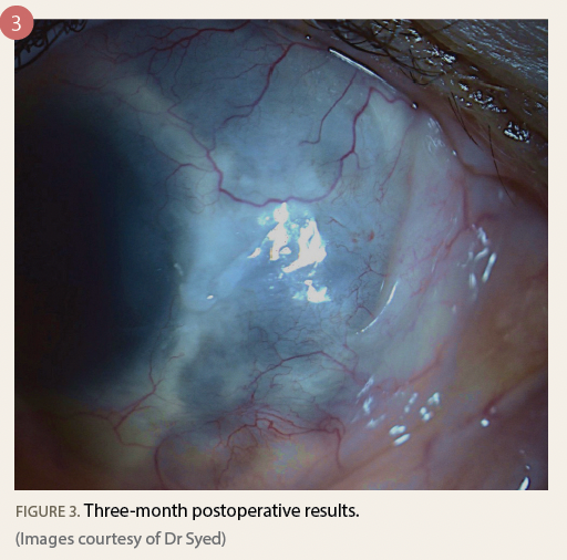Figure 3 shows the eye with three-month postoperative results. 