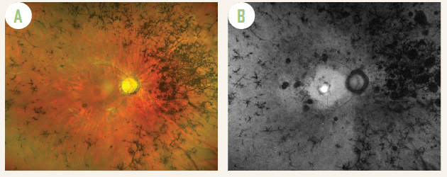 (A) Widefield colour imaging of the right fundus of a patient with USH2A-related Usher syndrome showing bone spicules pigmentation in the mid-periphery, arteriole attenuation and optic disc pallor.  (B) Widefield autofluorescence imaging of the right fundus of a patient with USH2A-related Usher syndrome showing ring of the hyperautofluorescence in the macula.