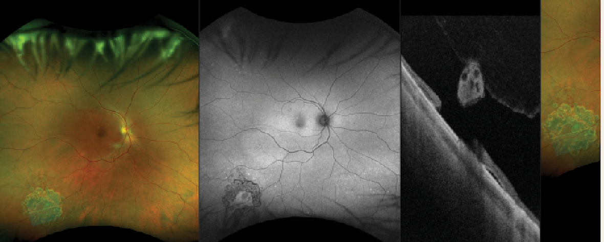 Ultrawidefield (UWF) RG scanning laser ophthalmoscopy (SLO) image, UWF autofluorescence SLO image and optical coherence tomography image of treated operculated retina hole. (Image courtesy of David Brown, MD, Retina Consultants of Texas)