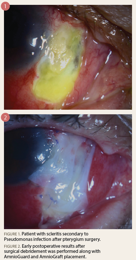 Figure 1 shows a patient with scleritis secondary to Pseudomonas infection after pterygium surgery. Figure 2 shows early postoperative results after surgical debridement was performed along with AmnioGuard and AmnioGraft placement.