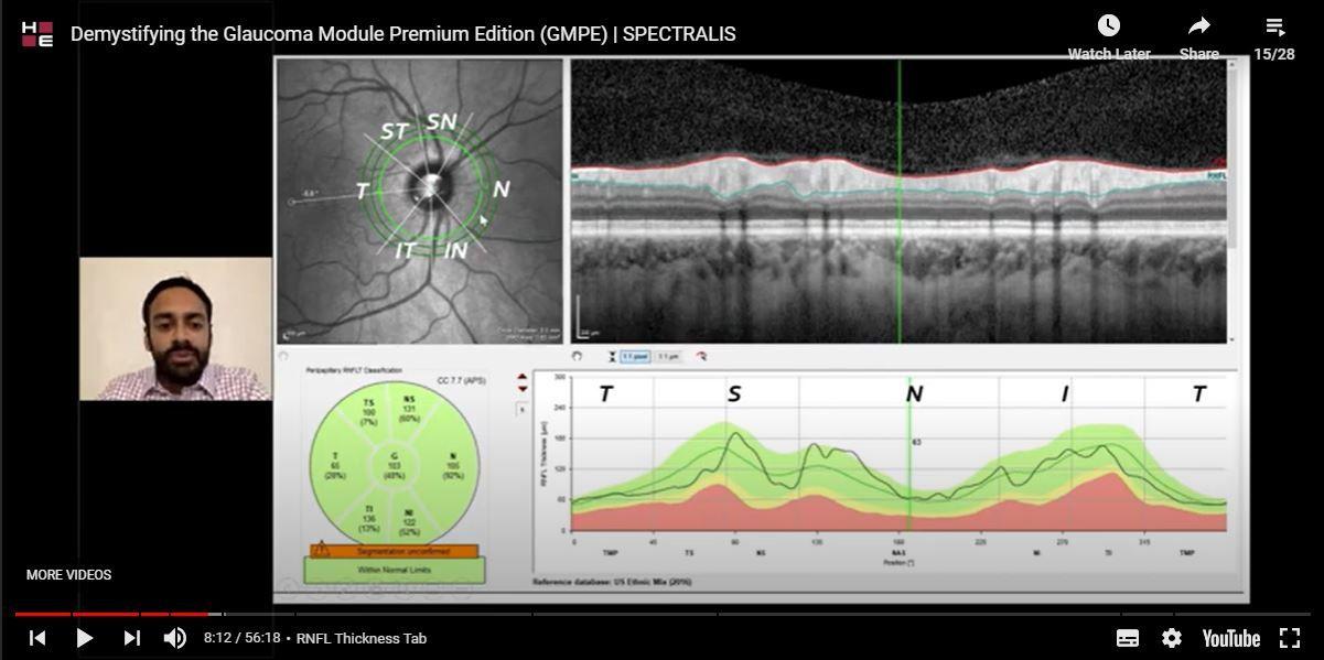 Video 2: Demystifying the Glaucoma Module Premium Edition (GMPE) by Dr. Swarup Swaminathan