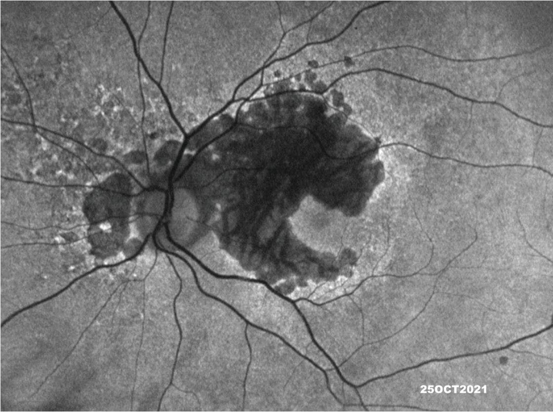 Figure 2. Hyperautofluorescent RPE cells along the border of the GA.