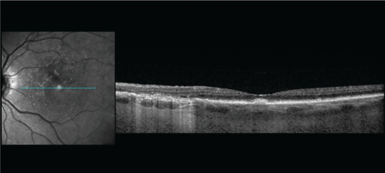 Figure 3. Early signs of GA are noted in the left side of the scan image, including hyper reflective foci, wedge defect, and iRORA (incomplete RPE and outer retinal atrophy). cRORA (complete RPE and outer retinal atrophy) is also present. (Images courtesy of Jeremiah Brown Jr, MD)