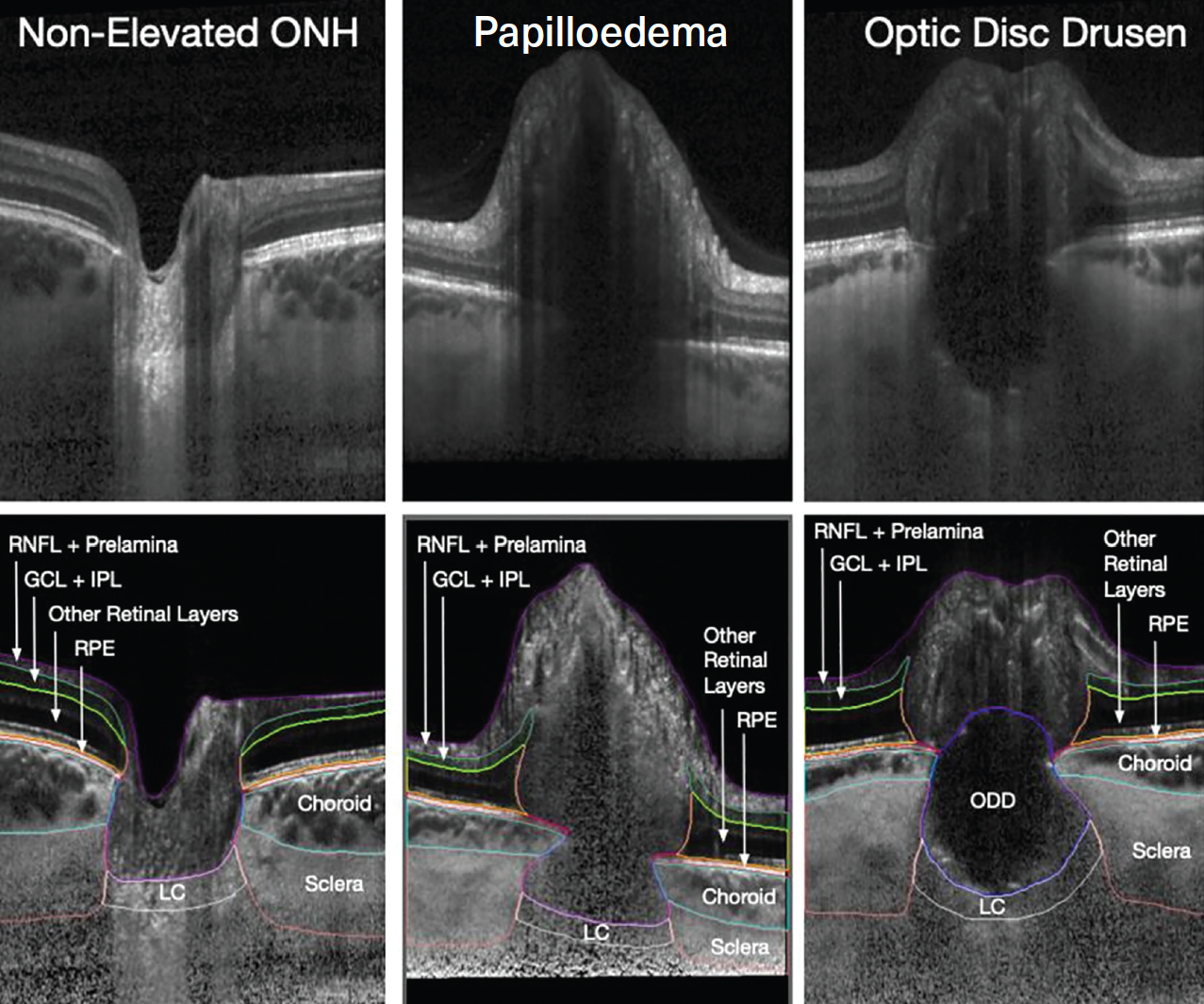 Figure. Manual segmentation of enhanced images shows healthy patients, those with papilloedema and those with ODD. (Image used with permission of Michaël J.A. Girard, MSc, PhD)