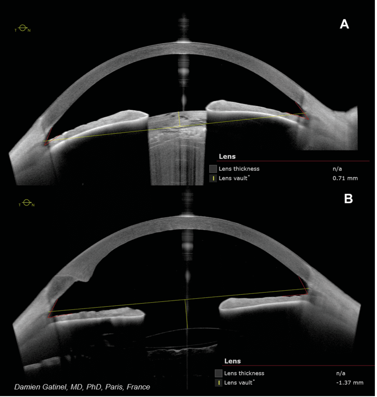 Image 2 — Same eye before (A) and after (B) cataract surgery, including measurements of lens vault and anterior chamber angles. Visualisation of dense lens, IOL, and lens capsule.