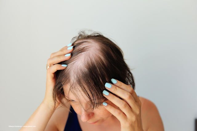 A person with alopecia areata examines their scalp. Image credit: ©Nadya Kolobova – stock.adobe.com
