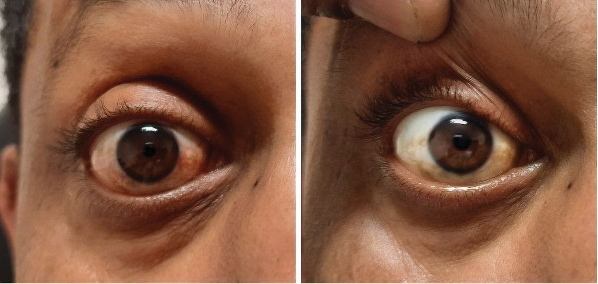 Clinical photos demonstrate conjunctival hyperemia and its resolution following an application of brimonidine tartrate 0.025%.