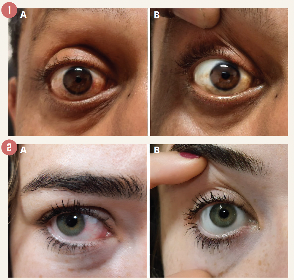 Figure 1 & 2. Clinical photos demonstrate conjunctival hyperemia (1a, 2a) and its resolution (1b, 2b) following an application of brimonidine tartrate 0.025%.  (Image courtesy of Jose Salgado-Borges, MD, PhD, FEBO)