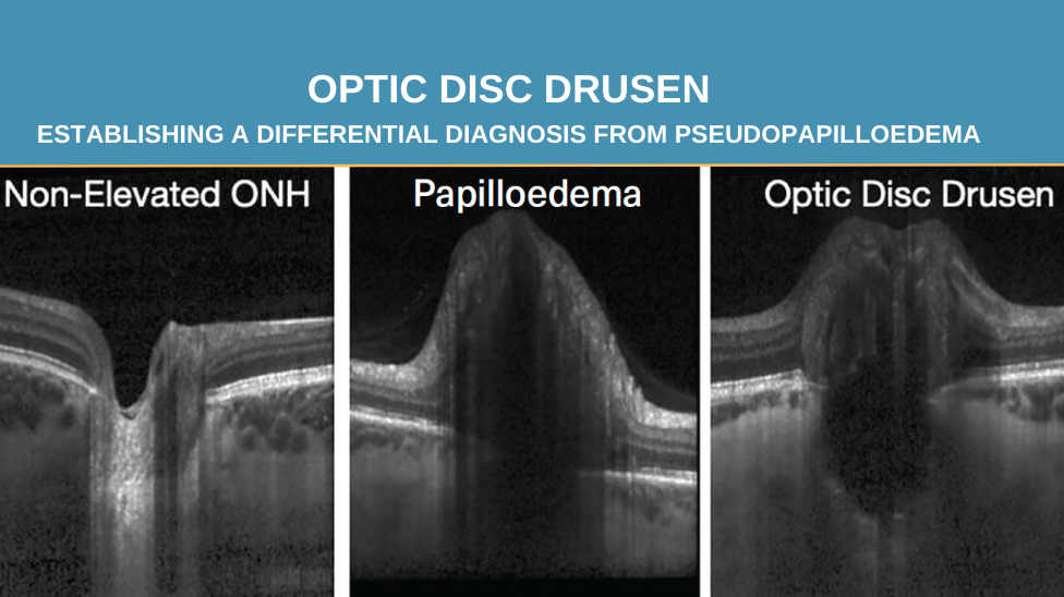 Manual segmentation of ocular images, titled, "OPTIC DISC DRUSEN establishing a differential diagnosis from pseudopapilloedema"