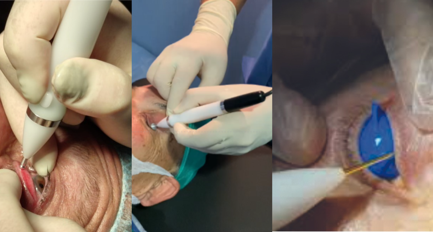 A plasma treatment device being used on the ocular surface. Images courtesy Magda Rau, MD.