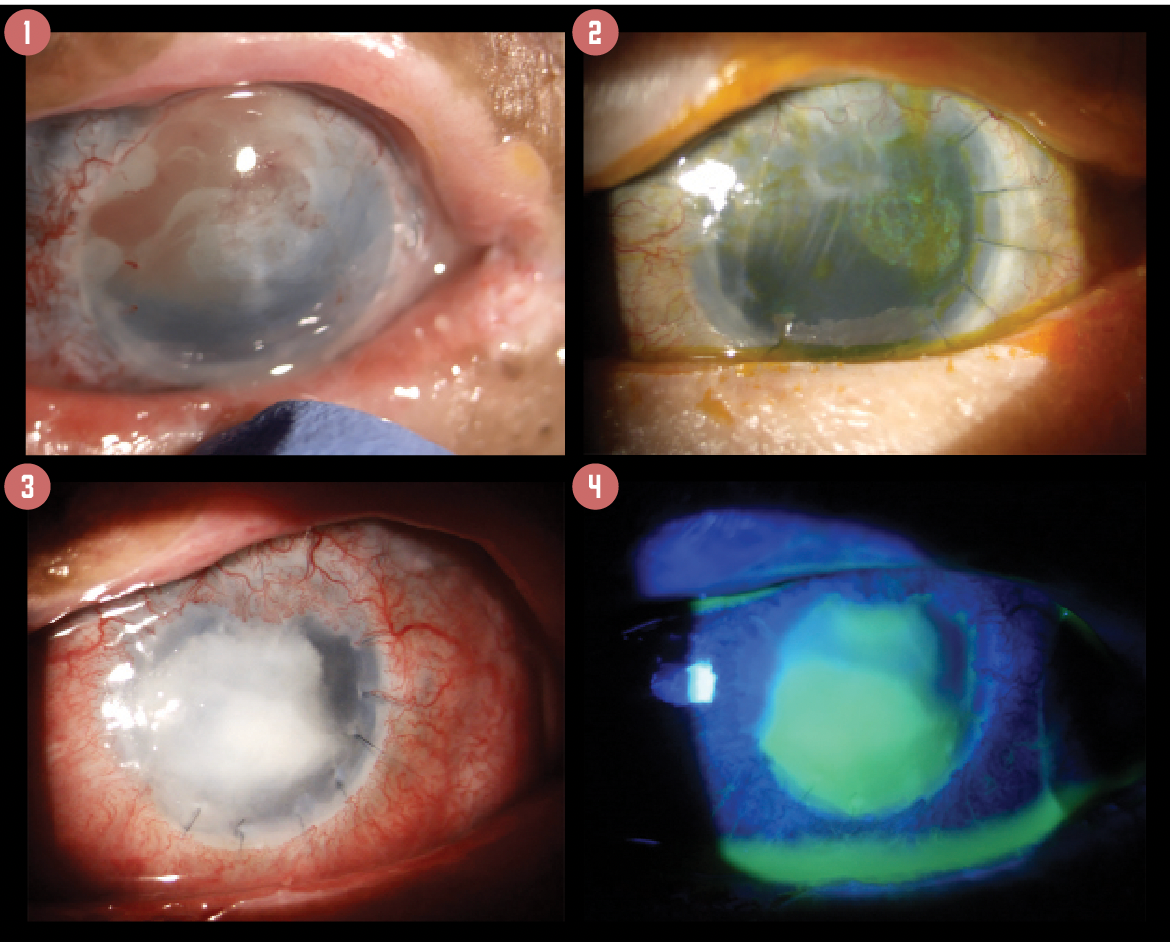 Figure 1. The surgical team addressed limbal stem cell deficiency in preparation for corneal grafting.  Figure 2. The patient’s condition remained unstable, with recurrent epithelial defects.  Figures 3, 4. A year after the last surgical attempt, the patient suffered another microbial keratitis episode, which manifested as a large corneal abscess with near-total epithelial defect.