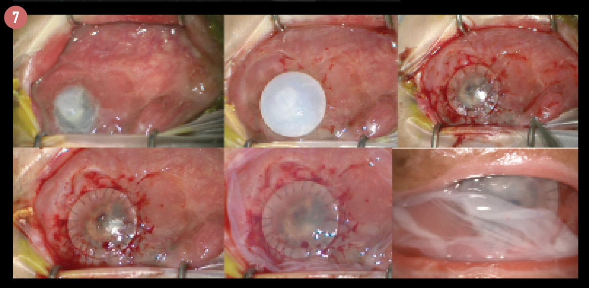 Figure 7. The author performed tectonic epikeratoplasty using an ethanol-preserved corneal button sutured onto the sclera, following a conjunctival peritomy fully covering the damaged area.  (Images courtesy of Artemis Matsou)