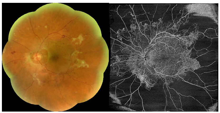 Figure 1 Multimodal imaging of proliferative diabetic retinopathy. 9-Field Montage fundus photography showing extensive fibrovascular proliferation. OCT-A showing extensive peripheral retinal ischemia and retinal neovascularization.