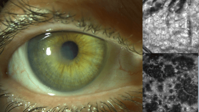 Images of eyes of patients with Fuchs endothelial corneal dystrophy