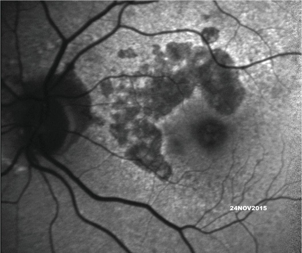 Hypoautofluorescence outlines an area of atrophy.