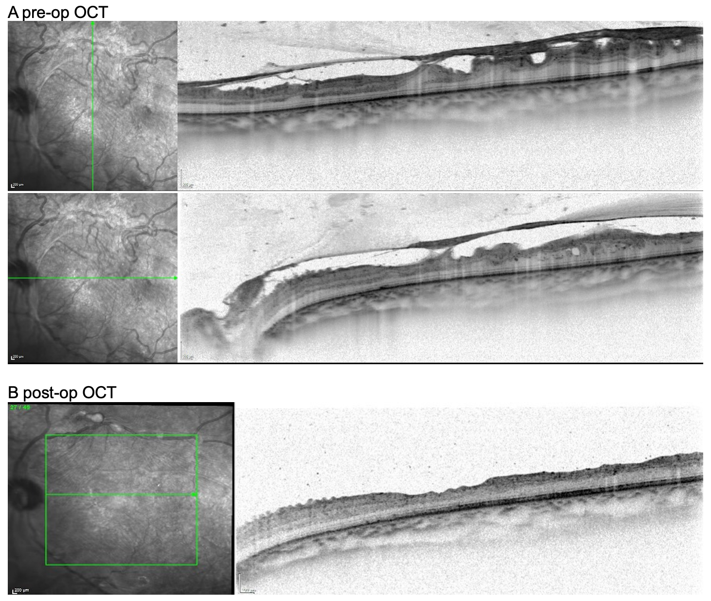 Figure 2 Case example 1: Pre-operative and post-operative macular OCT of a patient with proliferative diabetic retinopathy.