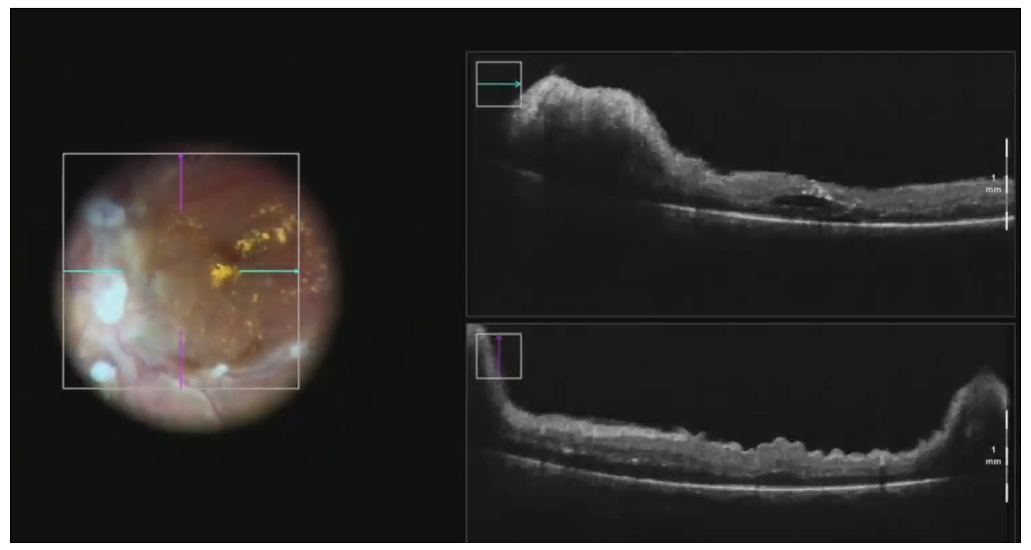 Figure 3 Case example 2: Utilization of iOCT to check macular status after the procedure.