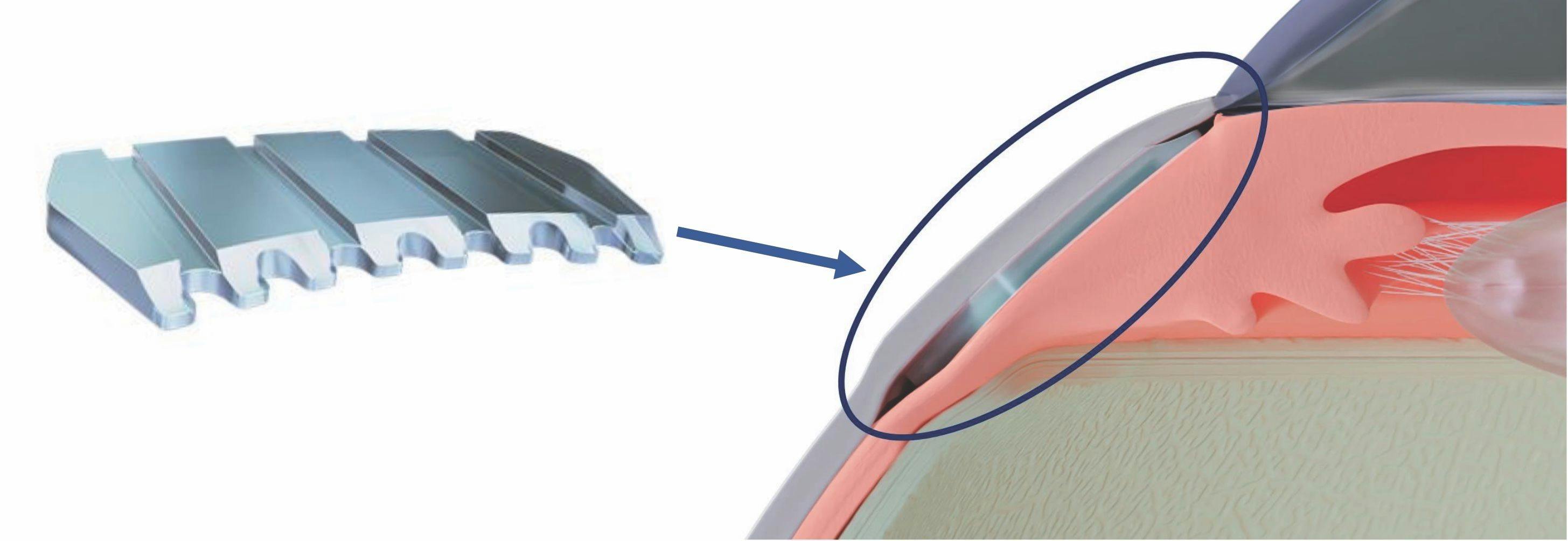 An illustration shows a schematic view of the Cilioscleral Interposition Device (CID). Courtesy Voskanyan, MD, PhD; V. Papoyan, MD; P. Sourdille, MD; O. Benoit, MEng; H. Miroyan, PhD.