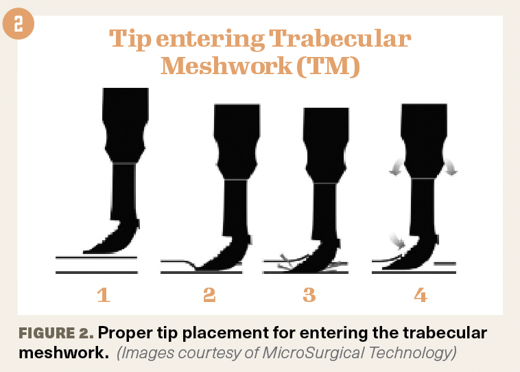 FIGURE 2. Proper tip placement for entering the trabecular meshwork.