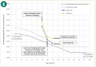 Example axial length growth of patient's right (blue) and left (yellow) eye in comparison with the underlying age-dependent physiological axial length growth. Tolerance range includes measurement inaccuracies. 
