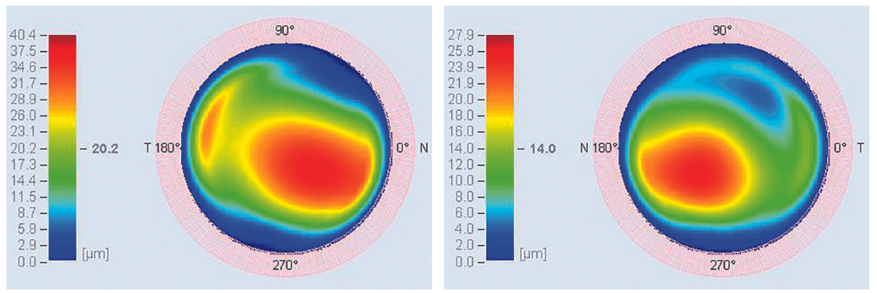 Figure 3. Planned ablation patterns OD (left) and OS (right). 