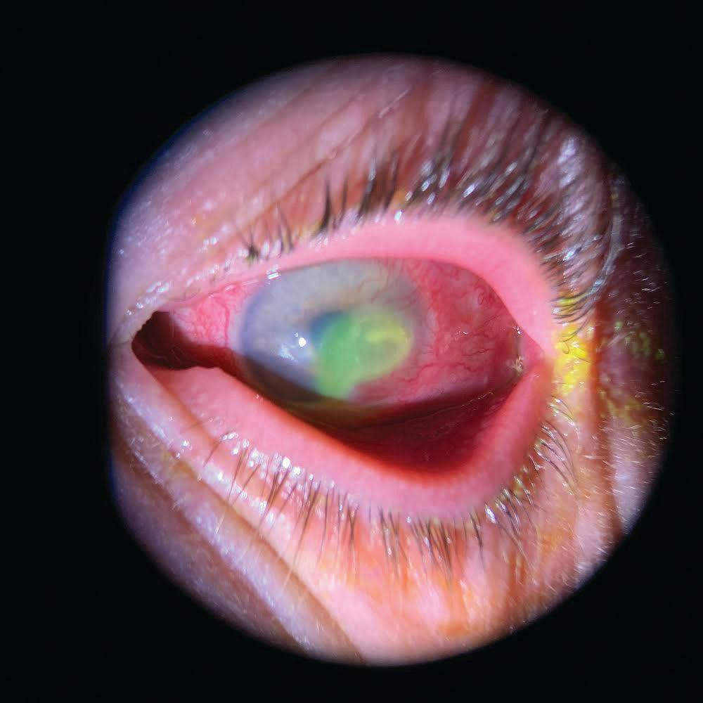 Slit lamp photograph demonstrating a large, paracentral infiltrate with overlying epithelial defect secondary to contact lens overwear.(Image courtesy of Brian Shafer, MD)