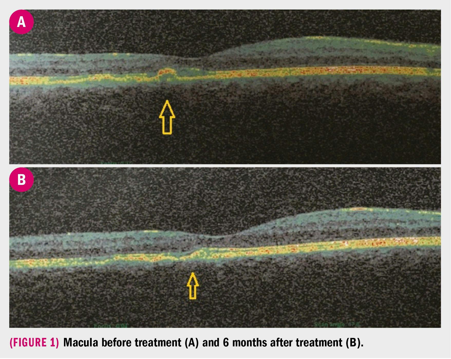 Macula before and after treatment