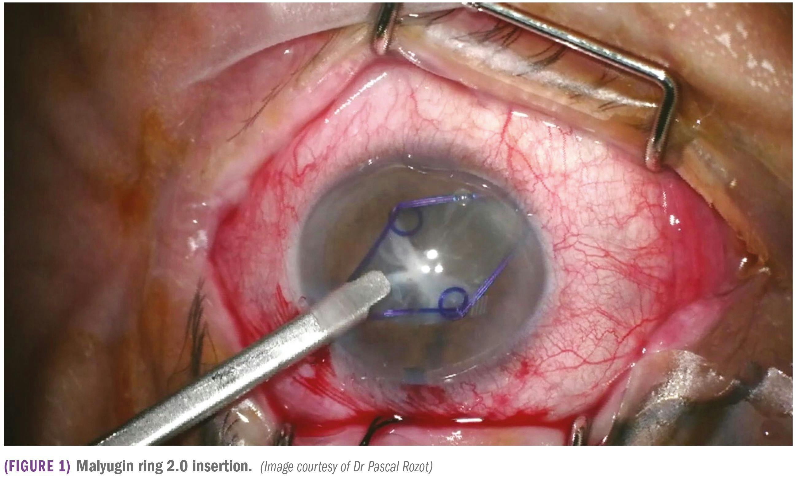 Malyugin ring 2.0 insertion during cataract surgery