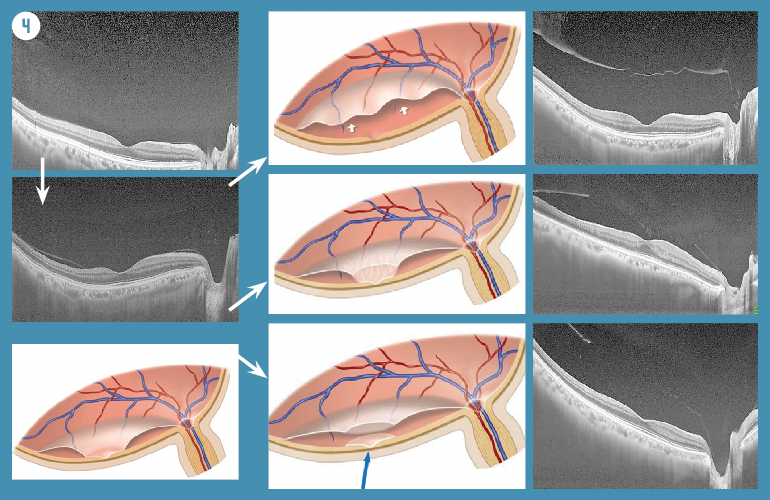Figure 4. Early phase of PVD progression. PVD progression begins from the state of No PVD (upper left) to the vicinity of the outer periphery of the macula (bottom left), then PVD spreads throughout the posterior pole (upper right). In many cases, an oval defect in the posterior vitreous cortex is formed (middle or lower right), and the thin posterior vitreous cortex remains on the macular retina (blue arrow). Among them, there are two types of shallow PVD with an oval defect in the posterior vitreous cortex. Shallow PVD with vitreous gel attachment to the macula through the premacular oval defect of posterior vitreous cortex (middle right) and no vitreous gel attachment to the macula (bottom right).