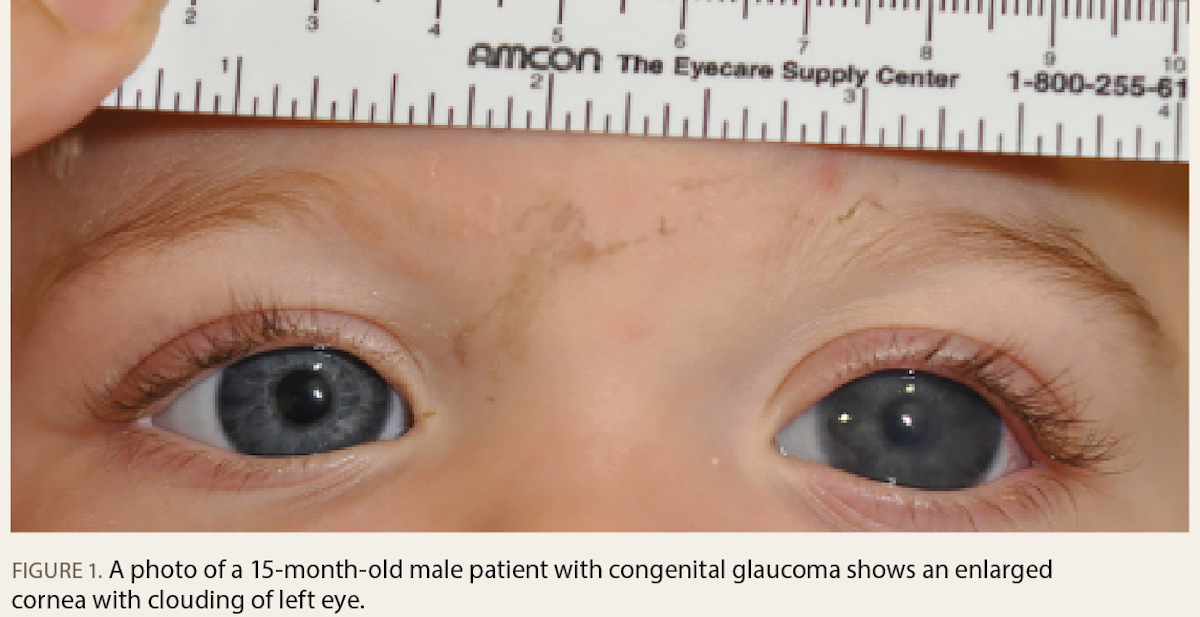 A photo of a 15-month-old male patient with congenital glaucoma shows an enlarged cornea with clouding of left eye. Image credit Dr Rosen