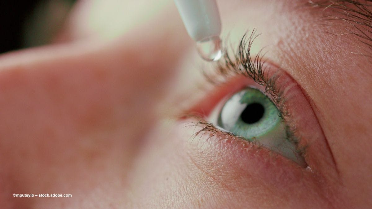 Treatment drops are placed in an open eye. Image credit: ©mputsylo – stock.adobe.com