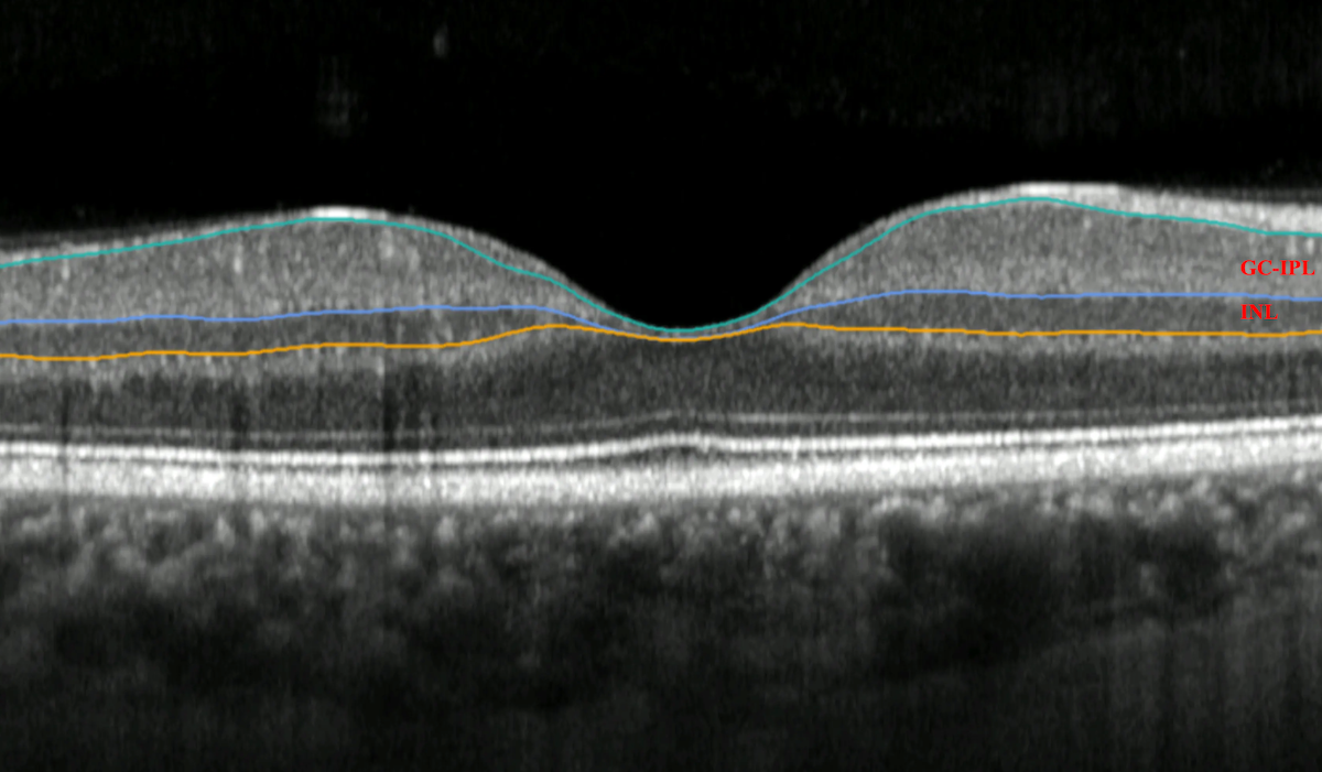 A scan shows the layers of the retina. Image courtesy of the researchers.