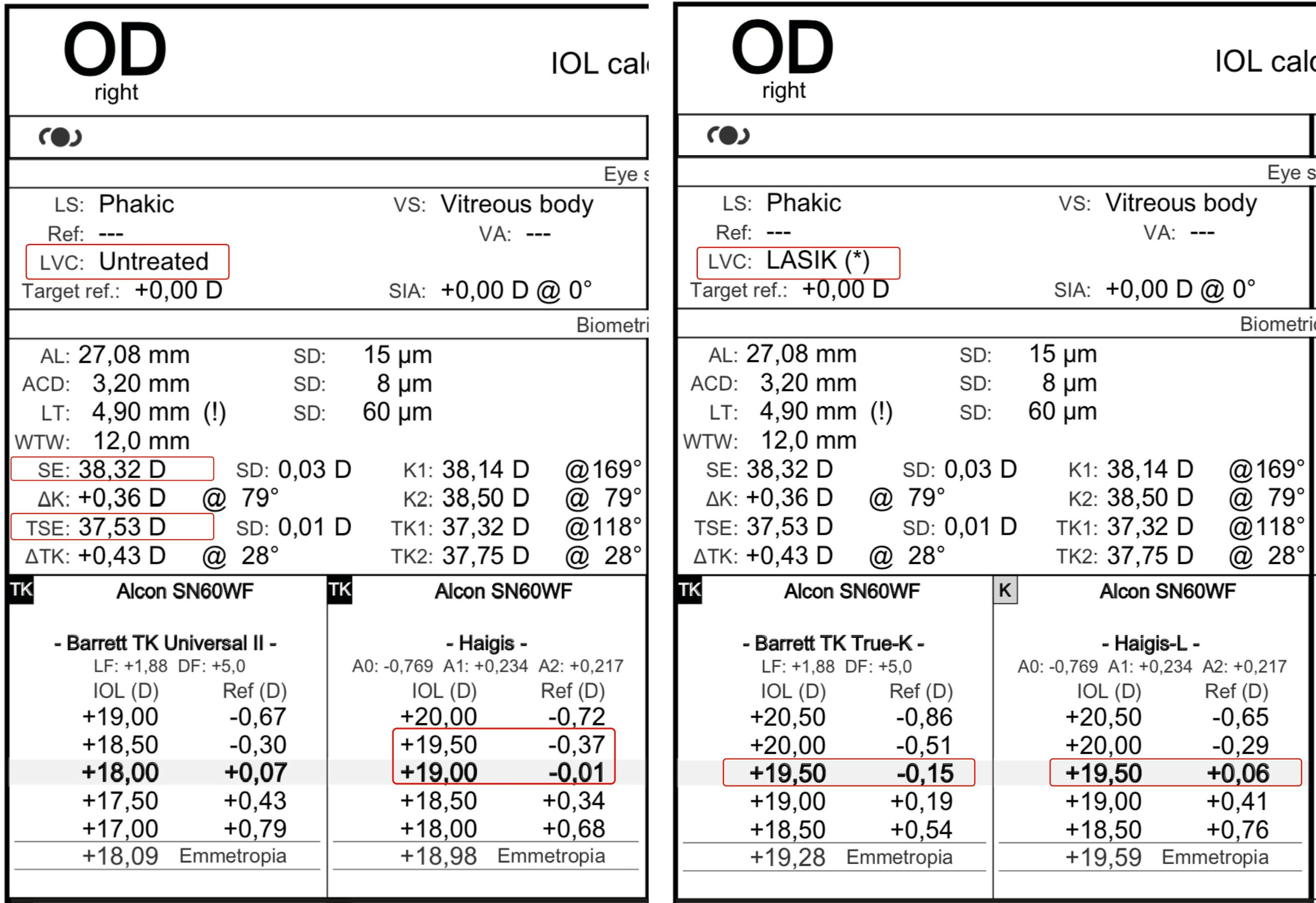 Figure 5 is an example of a post-LASIK patient who underwent cataract surgery and received a 19.5 D IOL with a postoperative refraction of0.25 D and a prediction error of0.12 D according to the combination of TK and Haigis formula. Panel (A) shows the IOLMaster 700 report for the eye using TK values (as if the patient had not previously had laser vision correction) using Haigis, and panel (B) shows the Barrett TK True K and Haigis L report where the patient was entered as a post-LASIK patient.