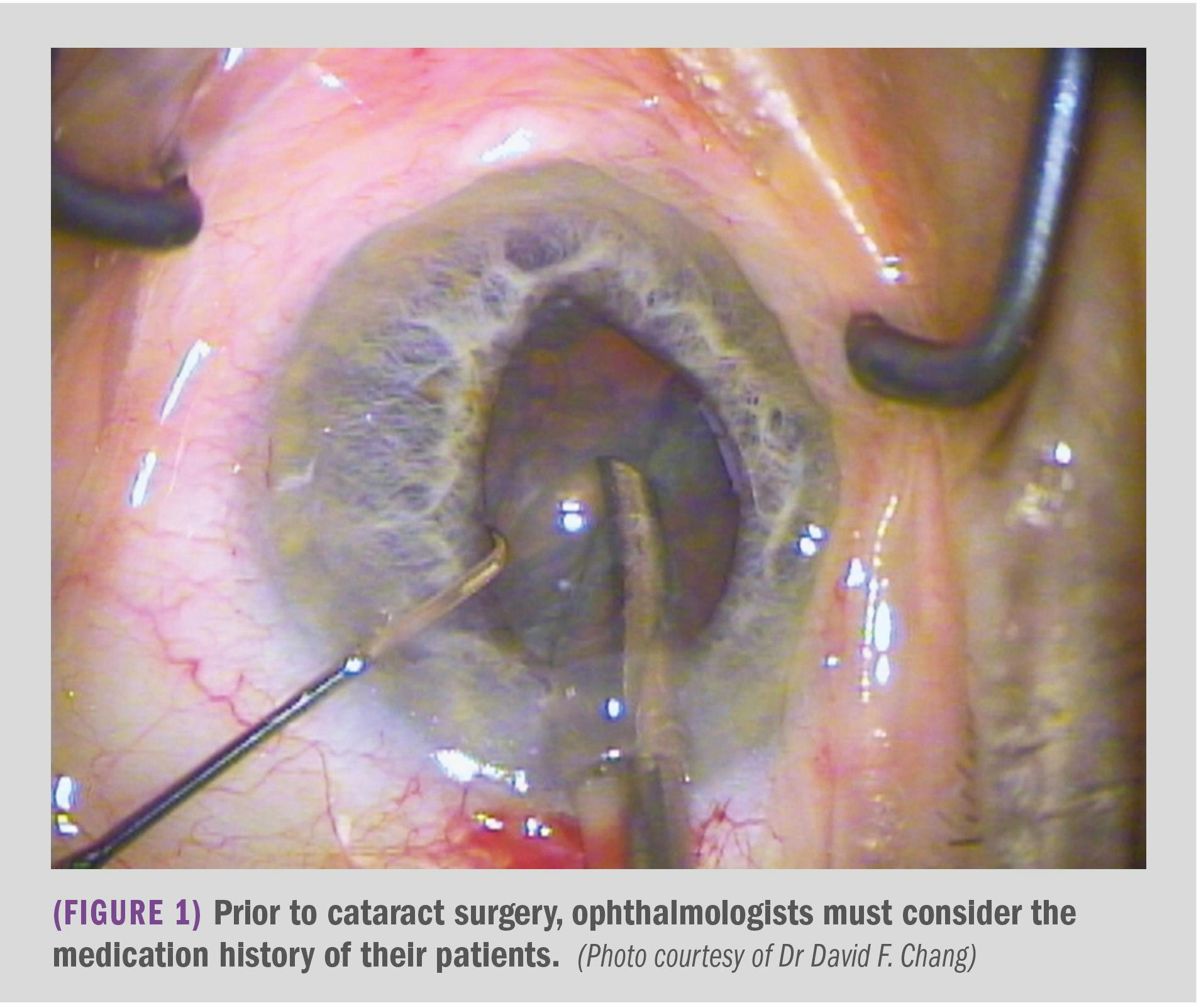 picture showing cataract surgery