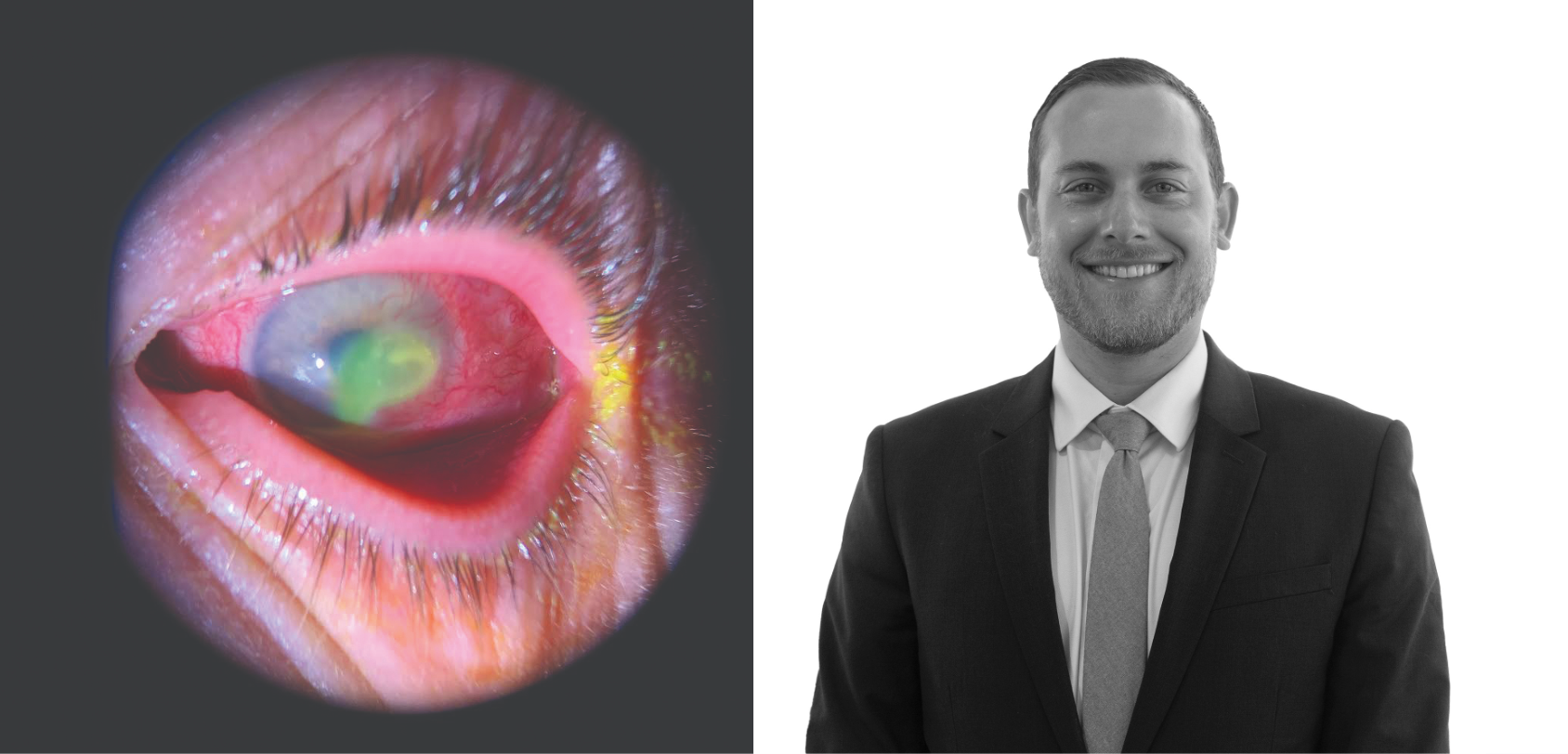 Fortified antibiotic advance improves corneal infection treatment paradigm