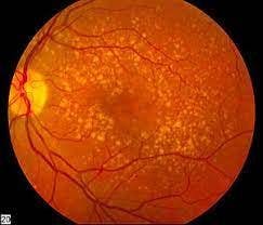 Non-viral gene therapy eases treatment burden in wet AMD