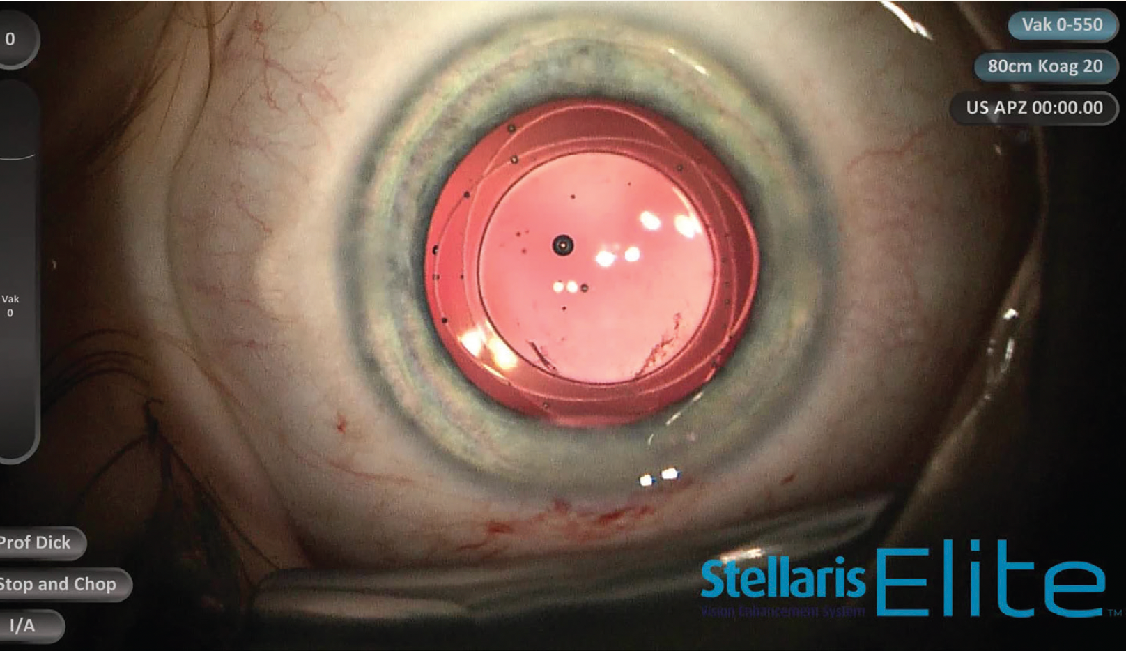 Preventing posterior capsule opacification in paediatric cataract surgery
