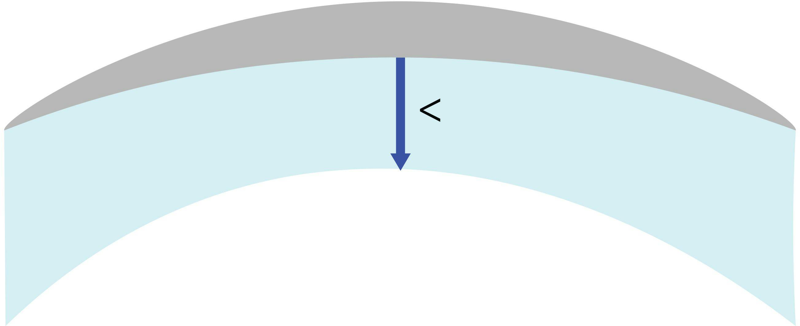 Figure 1 illustrates keratometric index error. Preoperatively (top), a fixed ratio between the anterior and posterior corneal curvature allows the calculation of the corneal power with the fictitious 1.3375 (or 1.3315) keratometric index. Postoperatively, the anterior corneal surface is flattened, the ratio is altered and the keratometric index leads to a wrong calculation of the corneal power, which is overestimated.